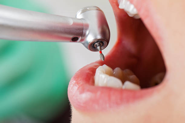 Best Emergency Dentist for Lost Fillings or Crowns in Gleneagle, CO